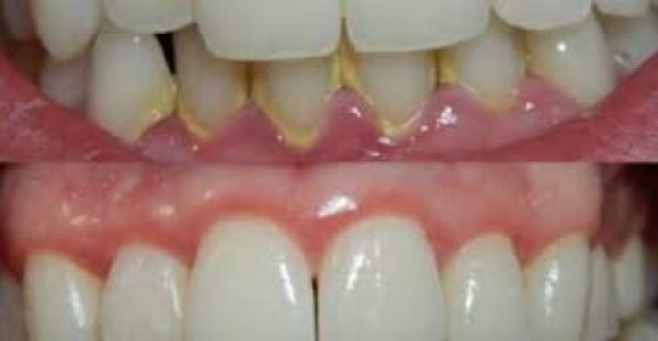 Δείτε πως να αφαιρέσετε την Οδοντική Πλάκα μέσα σε 5 Λεπτά, φυσικά, χωρίς να πάτε στον οδοντίατρο!!!