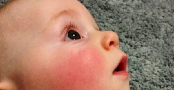 Είναι φυσιολογικό να έχει κόκκινα μάγουλα το μωρό;