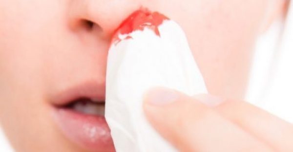 Αίμα από την μύτη: Τι πρέπει να κάνετε για να σταματήσει