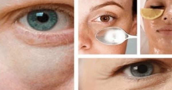 Featured Image for Σακούλες κάτω από τα μάτια: Γιατί δημιουργούνται και πώς θα τις αντιμετωπίσετε
