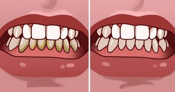 Πώς να αφαιρέσετε την πλάκα από τα δόντια σε λιγότερο από 5 λεπτά
