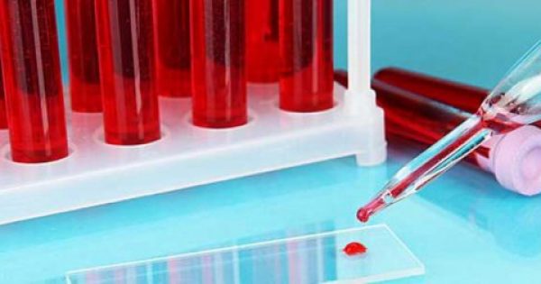 Τεστ αίματος ανιχνεύει τον καρκίνο ένα χρόνο πριν τις ακτινογραφίες και τις τομογραφίες