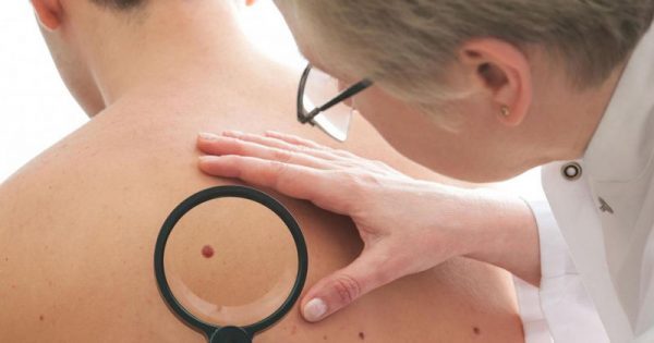 Καρκίνος δέρματος: 7 σημάδια που δεν πρέπει να αγνοείτε