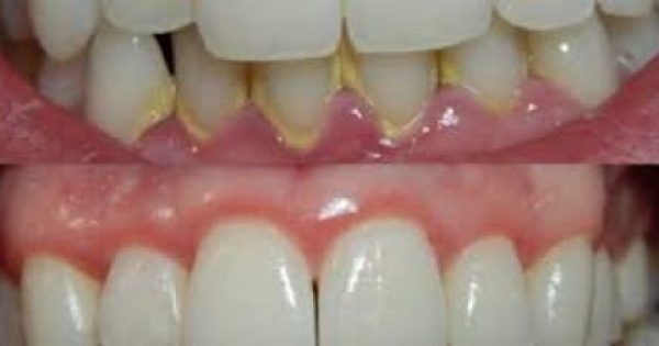 Δείτε πως να αφαιρέσετε την Οδοντική Πλάκα μέσα σε 5 Λεπτά, φυσικά, χωρίς να πάτε στον οδοντίατρο!!!