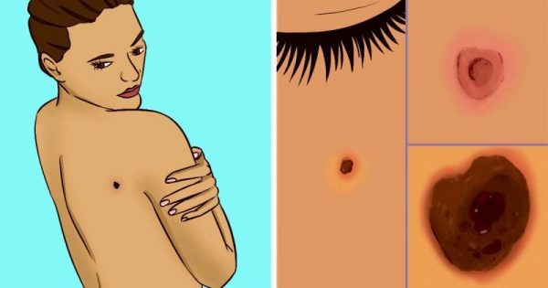 Τι να ψάξετε για να εντοπίσετε εγκαίρως τον καρκίνο του δέρματος