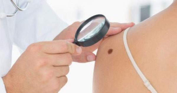 Έτσι θα αναγνωρίσετε τα επικίνδυνα συμπτώματα του καρκίνου του δέρματος