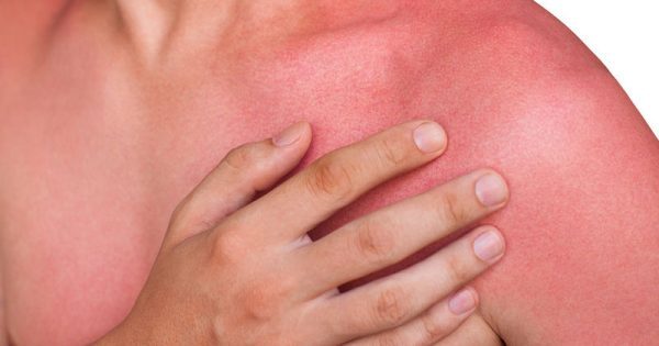 Τι συμβαίνει στο δέρμα όταν παθαίνουμε έγκαυμα;