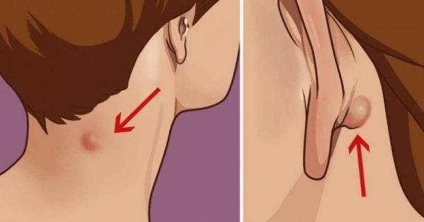 Έχετε ένα τέτοιο εξόγκωμα πίσω απ’το αυτί ή το λαιμό σας; Δείτε ΤΙ σημαίνει αυτό για την υγεία σας και πως να το αντιμετωπίσετε!!!