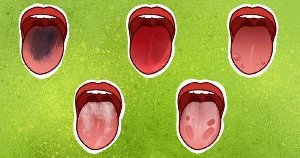 Τι λέει η γλώσσα σας για την υγεία σας – ΦΩΤΟ