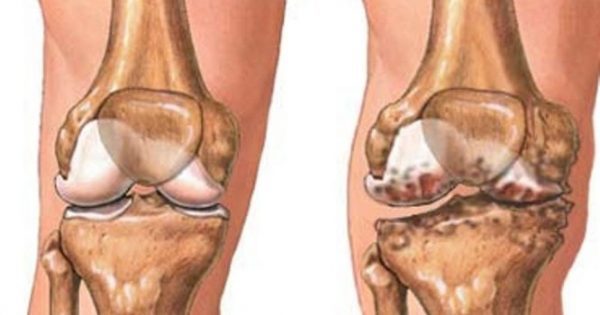Οστεοαρθρίτιδα γόνατος: Η ολική αρθροπλαστική δεν είναι μονόδρομος
