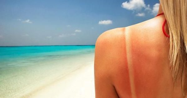 Δέρμα: «Λίγο βούτυρο για το έγκαυμα» και άλλοι μύθοι για το καλοκαίρι