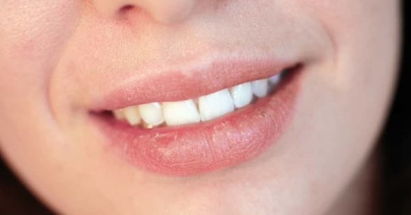 Ηλιακό έγκαυμα στα χείλια: Τρεις επιλογές θεραπείας που λίγοι γνωρίζουν