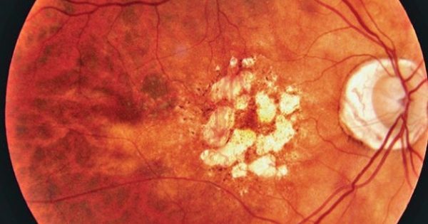 Ισχυρά οφέλη για την όραση των ασθενών με νεοαγγειακή Ηλικιακή Εκφύλιση Ωχράς από φάρμακο της Novartis