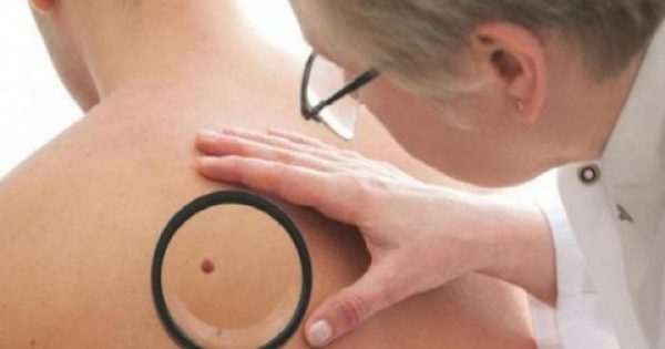 Καρκίνος του δέρματος: Όλα όσα θα πρέπει να γνωρίζεις για να προστατευτείς από τις επιπτώσεις του ήλιου