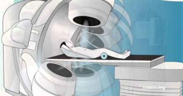 Featured Image for ΔΙΕΛΥΣΑΝ ΤΗΝ ΥΓΕΙΑ – Αποκλείονται από ακτινοθεραπείες 13.000 καρκινοπαθείς, αναφέρει η ΠΟΕΔΗΝ