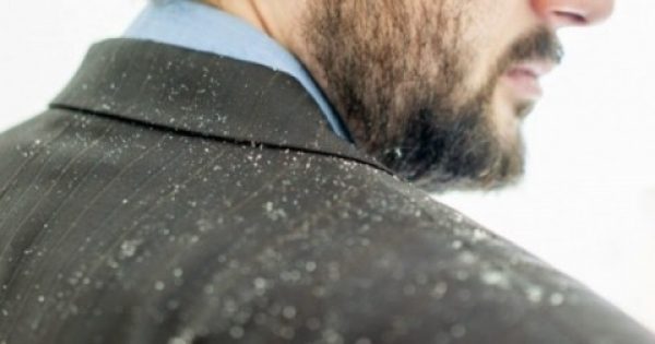 Featured Image for Δε θα πιστεύετε με τι εξαφανίζεται η πιτυρίδα!