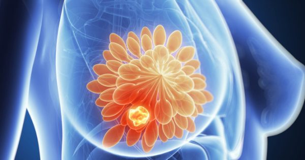 Νέα θεραπεία για τον προχωρημένο καρκίνο του μαστού HR+/HER2-