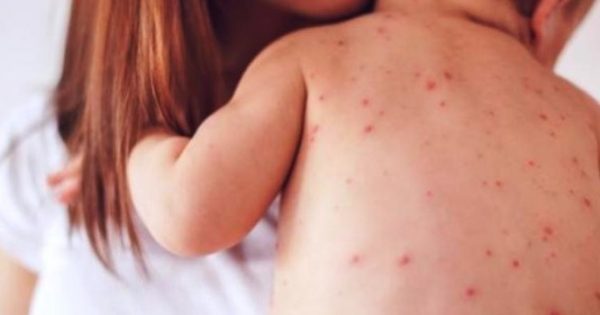 Ιλαρά: Τα εμβόλια είναι μονόδρομος για παιδιά και ενήλικες