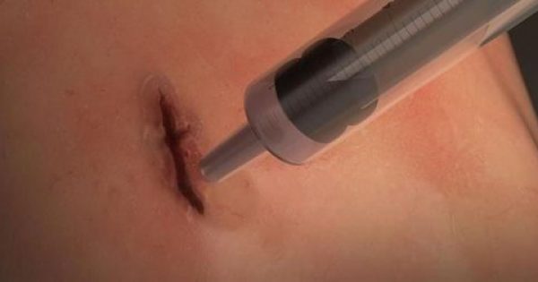 Featured Image for Επαναστατική χειρουργική κόλλα κλείνει τραύματα μέσα σε ένα λεπτό
