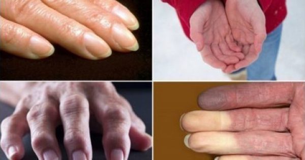 Δείτε πως τα χέρια και τα νύχια, μας δείχνουν την επικίνδυνη κατάσταση της υγείας μας