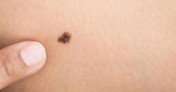 Ελιές στο δέρμα: Πώς θα καταλάβετε αν κάποια είναι καρκίνος