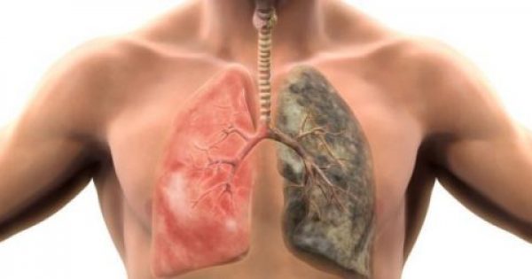 Ο καρκίνος του πνεύμονα δεν προτιμά μόνο τους καπνιστές