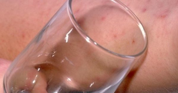 Μηνιγγίτιδα – Σημάδι στο δέρμα: Πώς γίνεται επιτόπου το “τεστ με το ποτήρι”