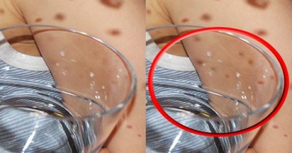 ΒΙΝΤΕΟ: Μηνιγγίτιδα – Σημάδι στο δέρμα: Πώς γίνεται επιτόπου το τεστ με το ποτήρι