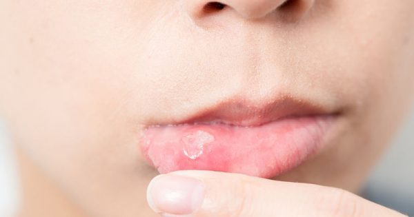 Υποτροπιάζουσες άφθες του στόματος: Ποια τα είδη τους και πώς τις αντιμετωπίζουμε