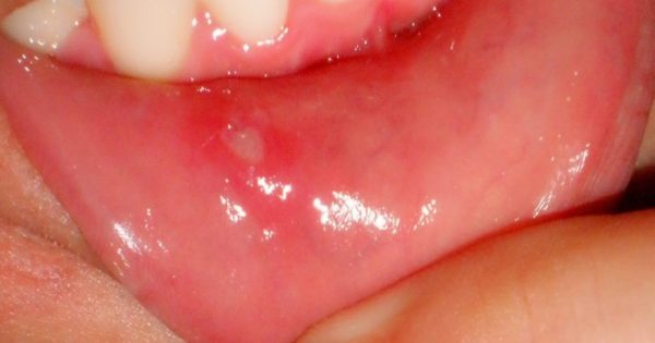 Άφθες (άφτρες) στο στόμα: Αίτια, συμπτώματα και αντιμετώπιση