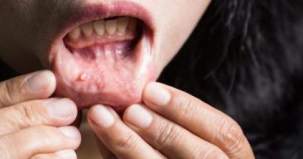 Καρκίνος του στόματος: Προσοχή στα «αθώα» συμπτώματα