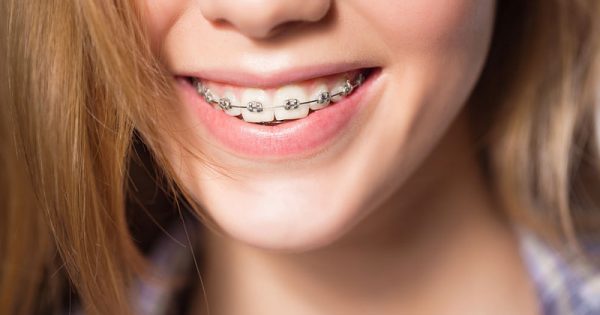 Σιδεράκια στα δόντια: Πρώτες βοήθειες για τα πιο συνηθισμένα απρόοπτα