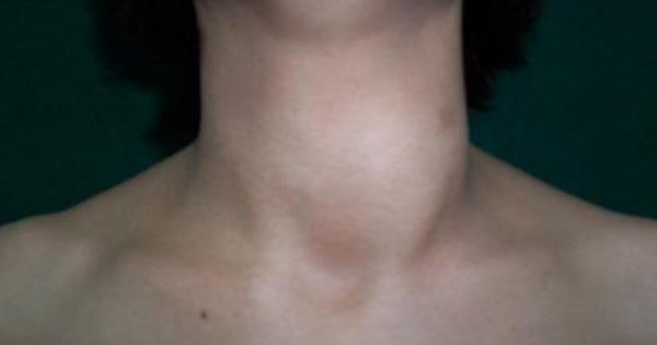 Featured Image for Γιατρέ έχω μία μάζα στο λαιμό μου και δε μπορώ να καταπιώ!!!