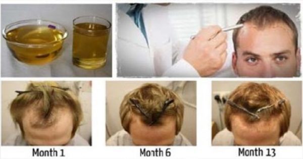 Πώς να σώσετε και να μακρύνετε τα μαλλιά σας με ένα μόνο συστατικό!!