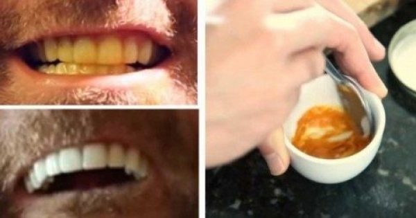 Αυτός ο Άνδρας μας Δείχνει ΠΩΣ να Λευκάνουμε Μόνοι τα Δόντια μας. Καταπληκτικό;