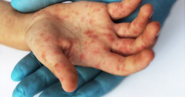 Προβληματισμός για την επιδημία ιλαράς στην Ελλάδα