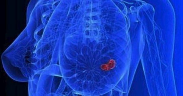 Έρευνα:Η ασπαραγίνη, σε πολλά τρόφιμα, ευνοεί την εξάπλωση του καρκίνου του μαστού