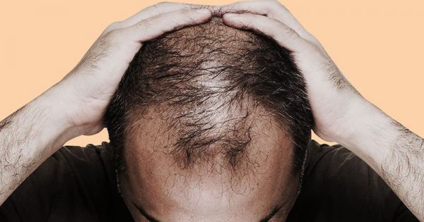 Ανδρική τριχόπτωση: 6 λόγοι που οι άνδρες χάνουν τα μαλλιά τους πρόωρα