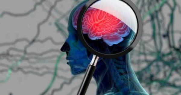 Ανεύρυσμα εγκεφάλου: «Αθώα» πρώιμα συμπτώματα