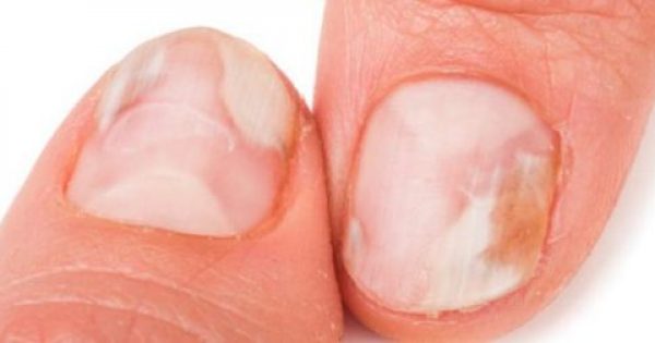 Μύκητες στα νύχια χεριών και ποδιών: 8 κανόνες πρόληψης