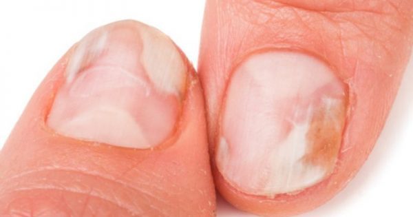 Μύκητες στα νύχια χεριών και ποδιών: Οι 8 κανόνες πρόληψης!!!