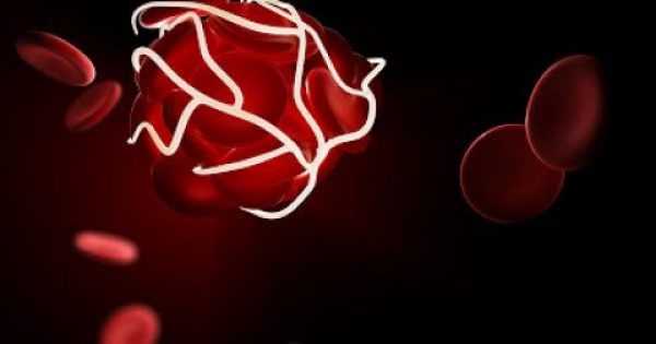 Θρόμβος στο αίμα: 7 σιωπηλά σημάδια που πρέπει να γνωρίζετε