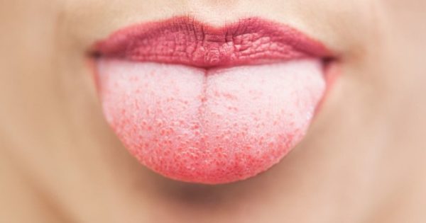 Featured Image for Λευκή γλώσσα: Γιατί συμβαίνει – Πότε είναι ανησυχητικό