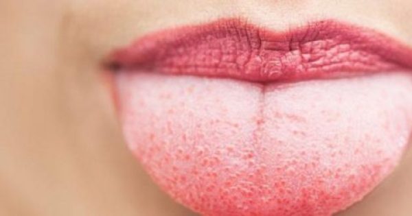 Featured Image for Προσοχή: Τι ασθένειες μαρτυρά το χρώμα της γλώσσα σας