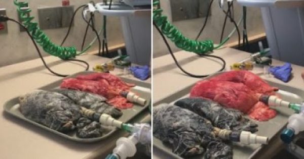 «Τσιγαράκι θέλετε;» Νοσοκόμα ανέβασε στο Facebook βίντεο- σύγκριση πνευμόνων καπνιστή και μη καπνιστή