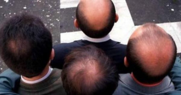 Featured Image for Ανάσα για εκατομμύρια άνδρες – Επιστήμονες ισχυρίζονται ότι βρήκαν την θεραπεία της φαλάκρας!