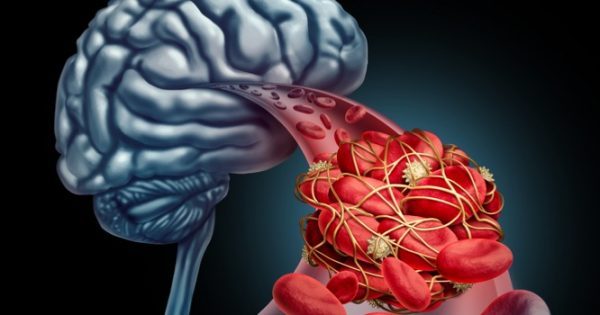 Εγκεφαλικό: Τι προσθέτουν στην ασπιρίνη, για να μειώσουν τον κίνδυνο!