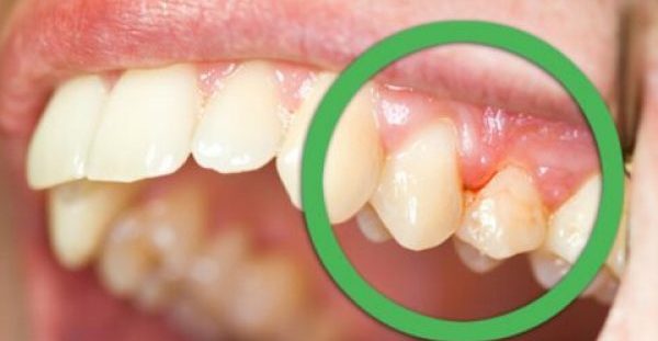 Φυσικές θεραπείες για ούλα που ματώνουν και δόντια που κουνιούνται!!!