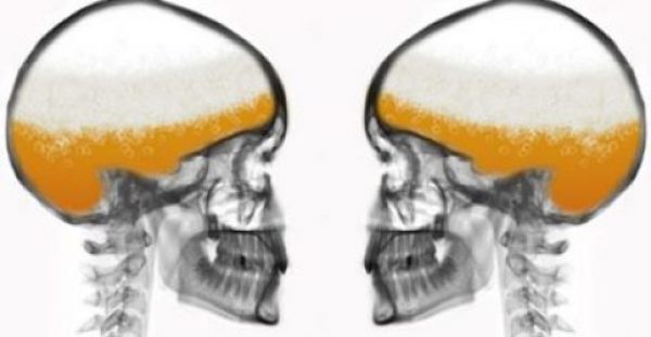 2 ποτήρια μπύρας είναι πιο αποτελεσματικά για την ανακούφιση του πόνου από τη παρακεταμόλη