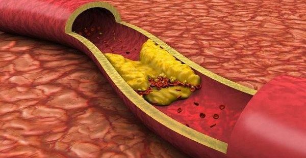 8 εκπληκτικοί τρόποι για την καταπολέμηση της χοληστερίνης και της υψηλής πίεσης του αίματος